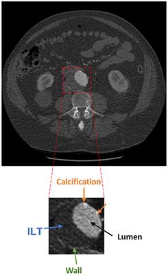 Deep-learning method for fully automatic segmentation of the abdominal aortic aneurysm from computed tomography imaging